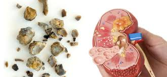 Illustration for article titled contoh obat batu ginjal